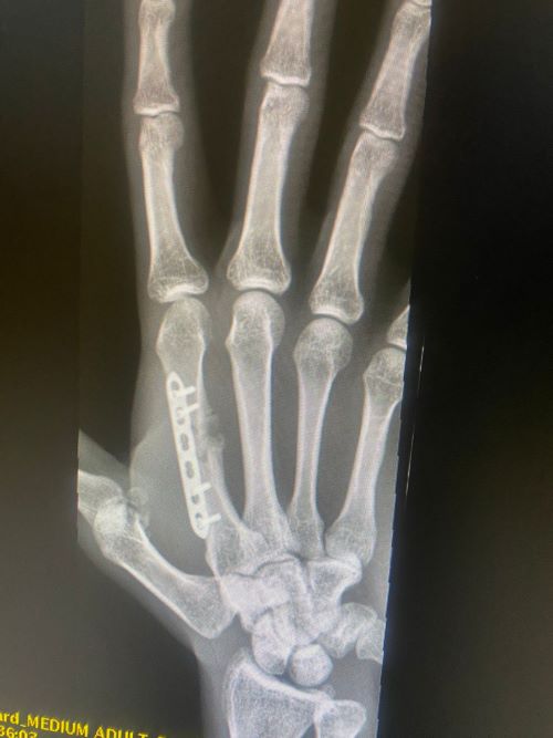 Overcoming Adversity: How Fadi Jaber Won His MMA Fight with a Broken Hand